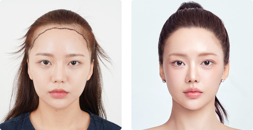 Before/After Front