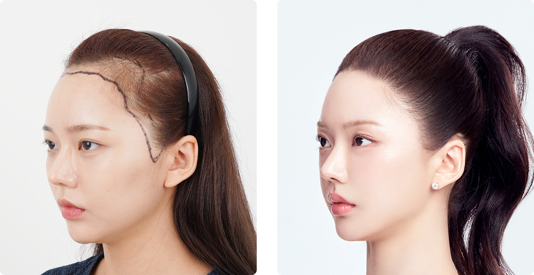 Before/After Side (Left)