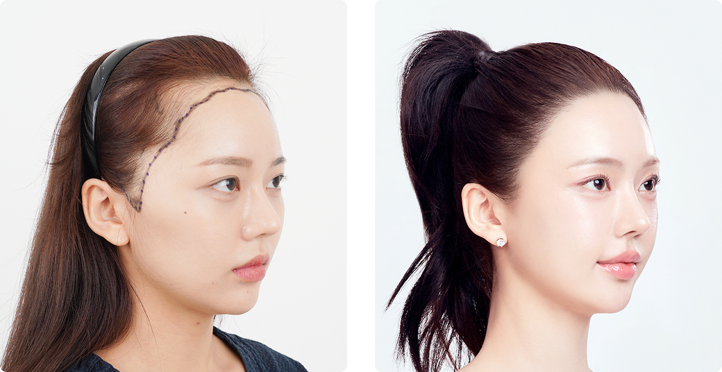 Before/After Side (Right)
