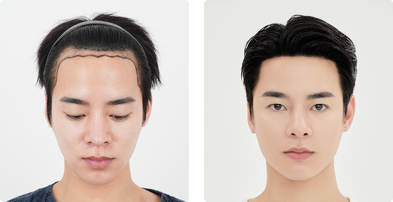 Before/After Front