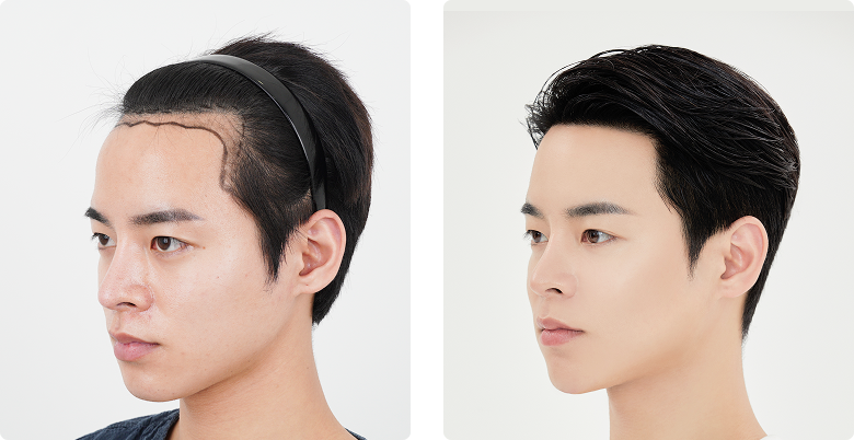Before/After Side (Left)