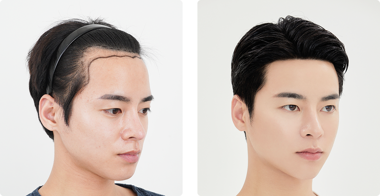 Before/After Side (Right)