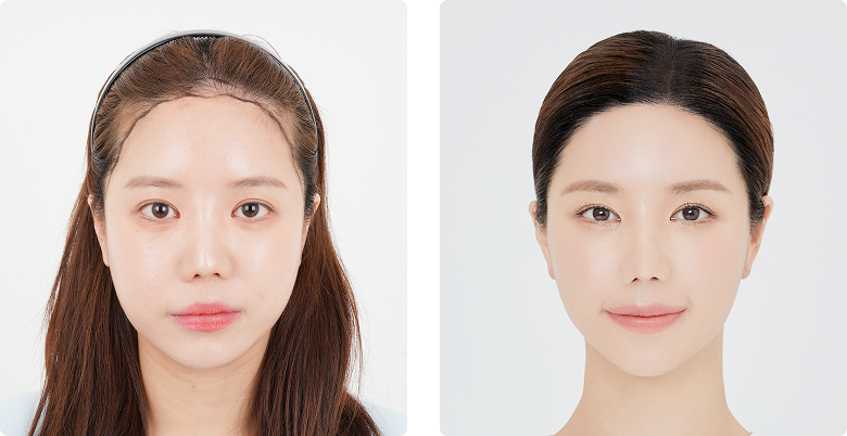 Before/After 正面