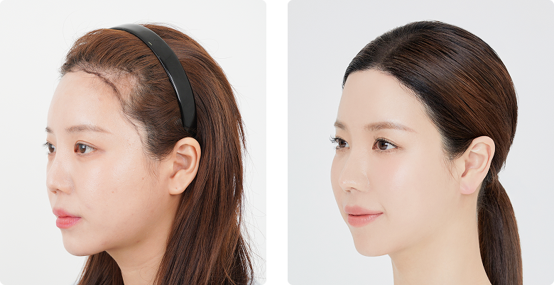 Before/After 側面(左)
