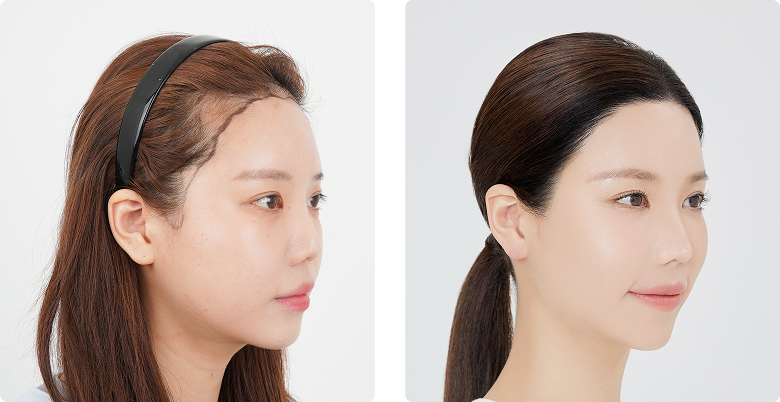 Before/After 側面(右)
