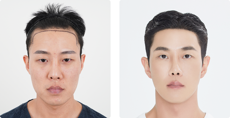 Before/After 正面
