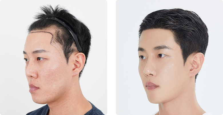 Before/After 側面(左)