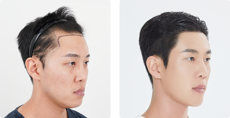 Before/After 側面(右)