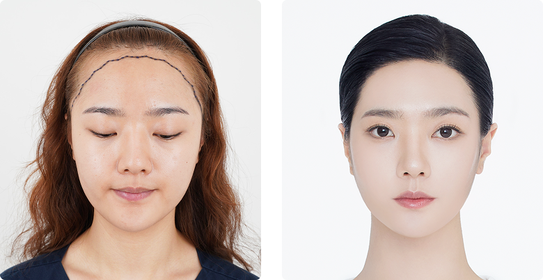 Before/After Front