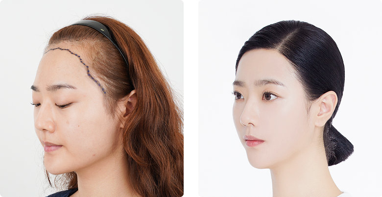 Before/After Side (Left)