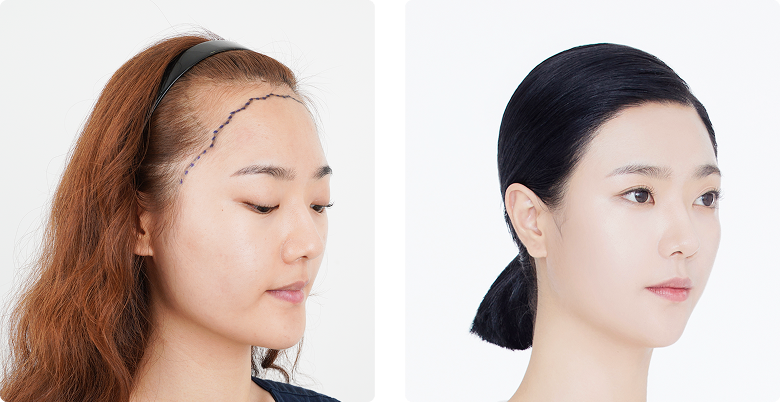Before/After Side (Right)