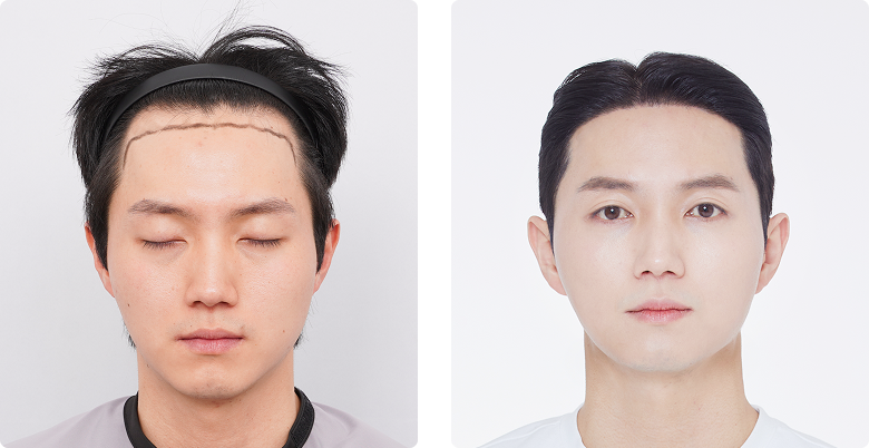 Before/After Front