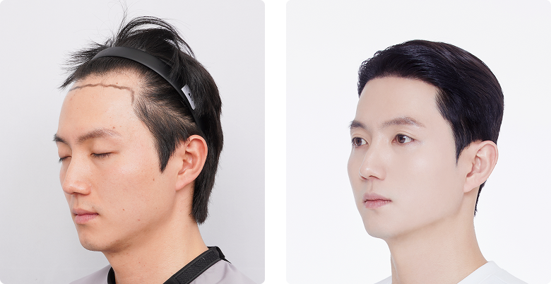 Before/After Side (Left)