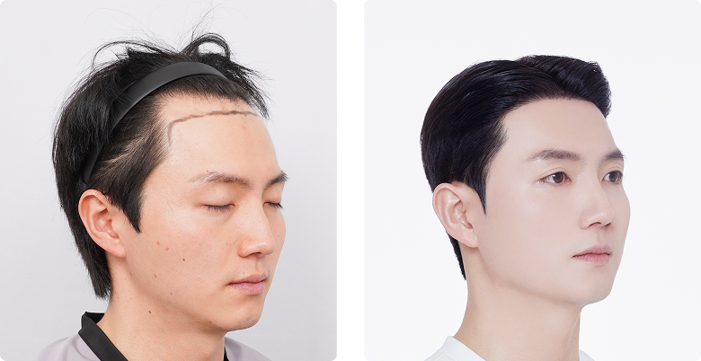 Before/After Side (Right)