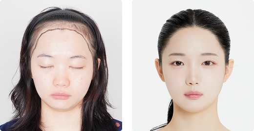Before/After Front