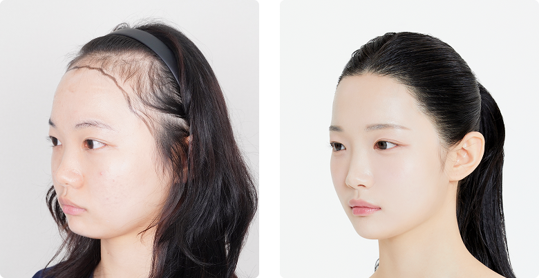 Before/After Side (Left)