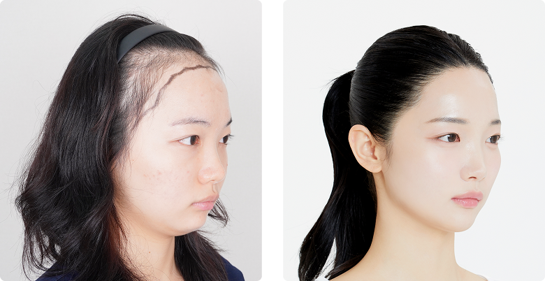 Before/After Side (Right)