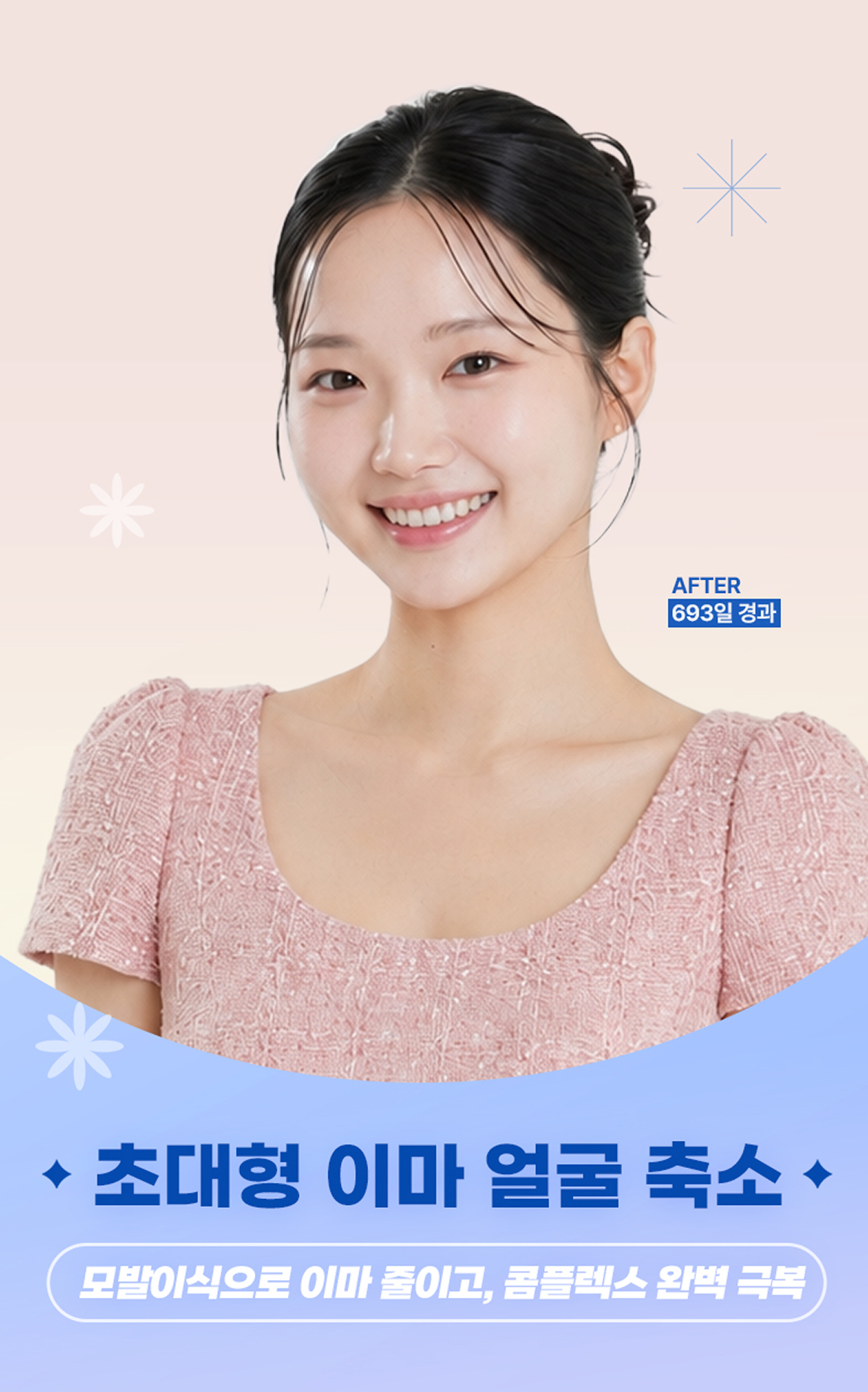 얼굴 축소 대량 모발이식