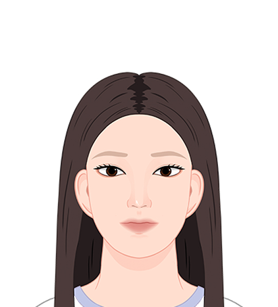 卵型