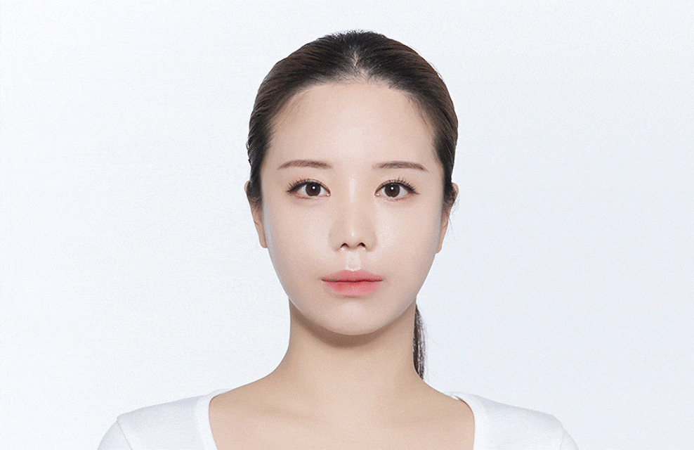 Hairline deformation due to surgery
