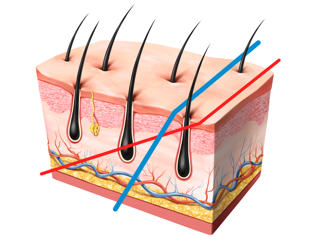 Male-centered design incision site hair loss / scar