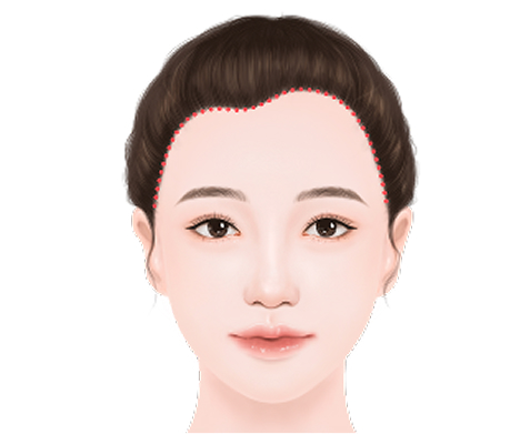 비대칭 이마